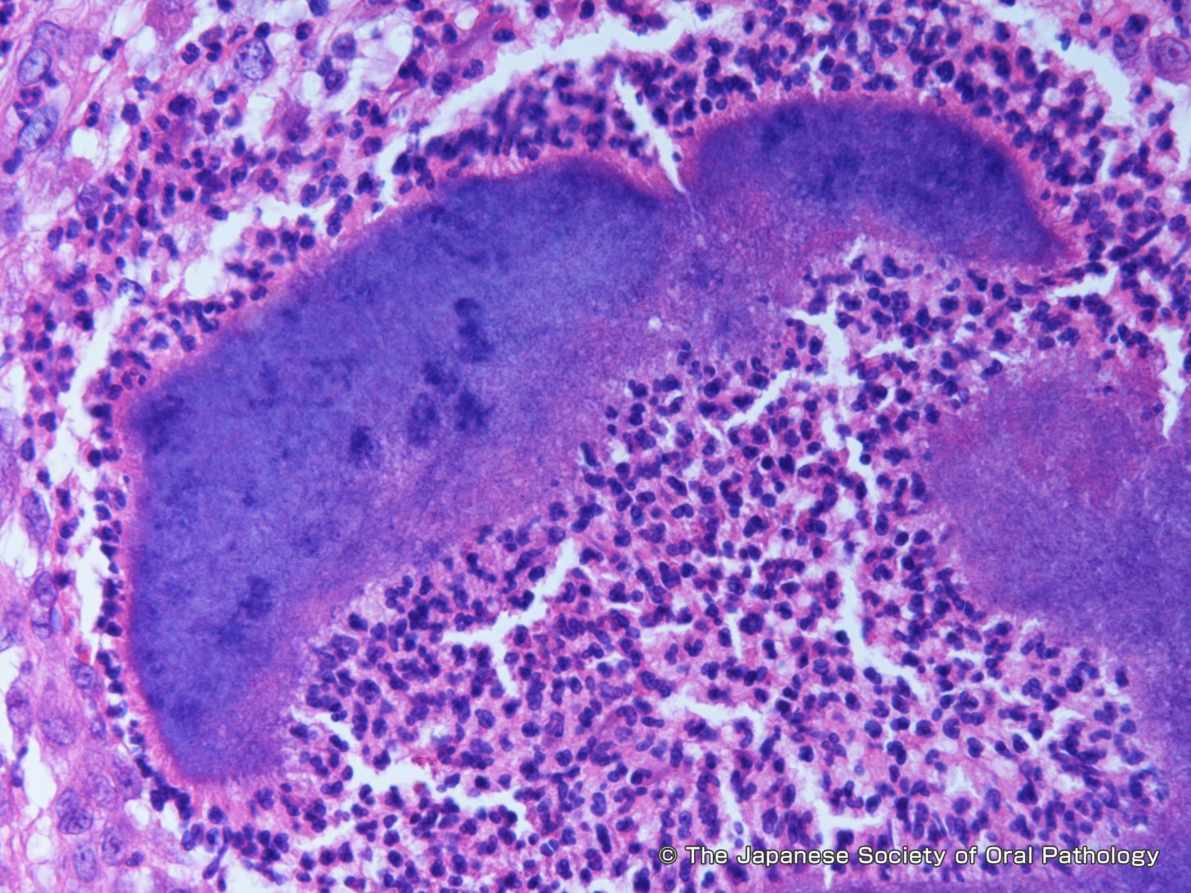 肺放線菌症はどうすれば予防できるのでしょうか?