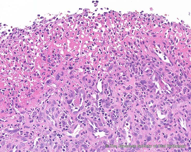 口内炎を引き起こす可能性のある薬