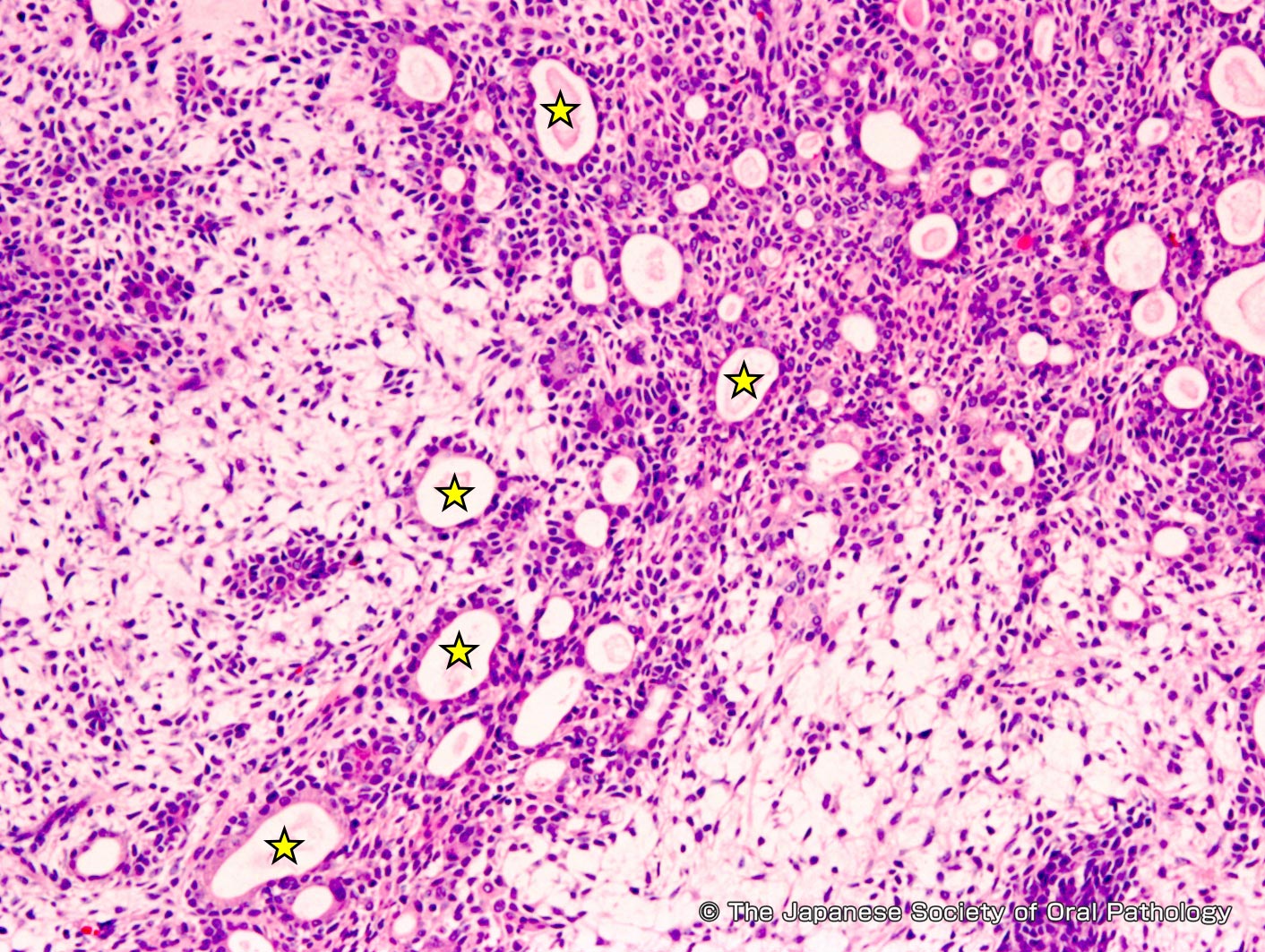 医師は多形腺腫からの癌をどのように診断しますか?